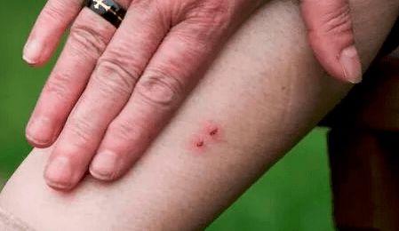 咬伤之后,咬伤后的紧急处理与预防措施全解析